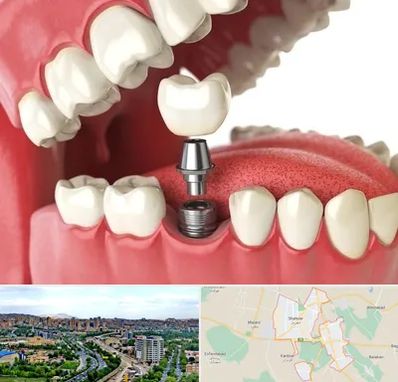 متخصص پروتز دندان در شهریار