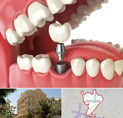 متخصص پروتز دندان در مینی سیتی
