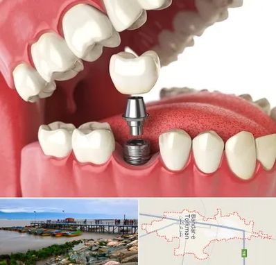 متخصص پروتز دندان در بندر ترکمن