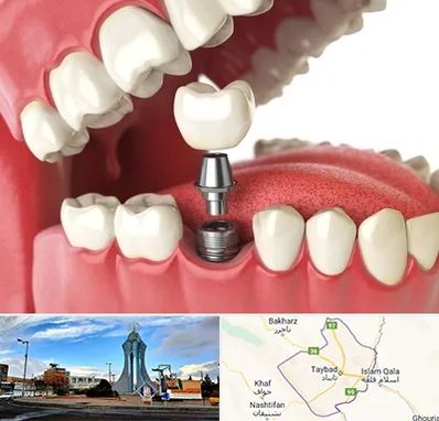 متخصص پروتز دندان در تایباد