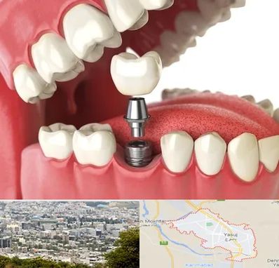 متخصص پروتز دندان در یاسوج