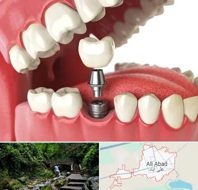 متخصص پروتز دندان در علی آباد کتول