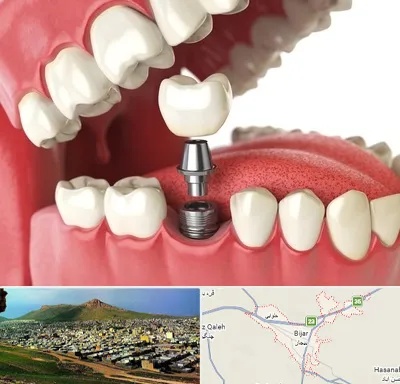 متخصص پروتز دندان در بیجار