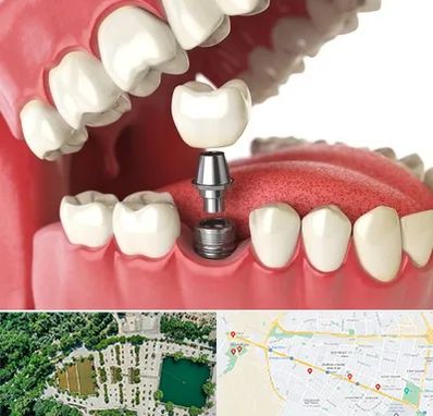 متخصص پروتز دندان در وکیل آباد مشهد