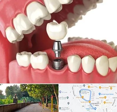 متخصص پروتز دندان در فلکه گاز رشت