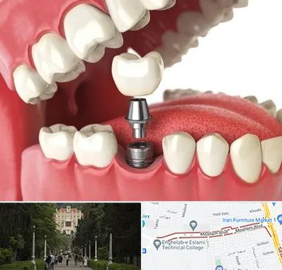 متخصص پروتز دندان در بلوار معلم رشت