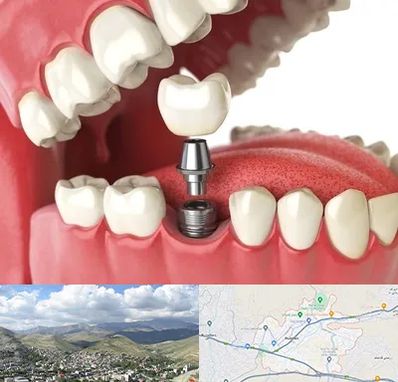 متخصص پروتز دندان در رودهن