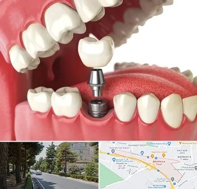 متخصص پروتز دندان در مهرویلا کرج