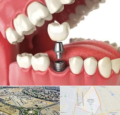 متخصص پروتز دندان در اندیشه