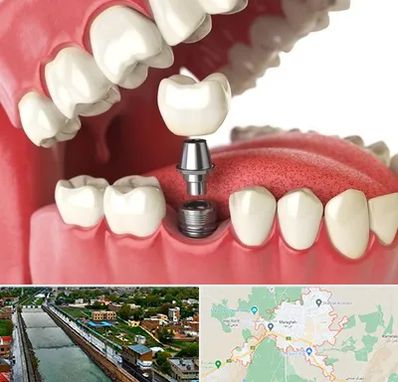 متخصص پروتز دندان در مراغه