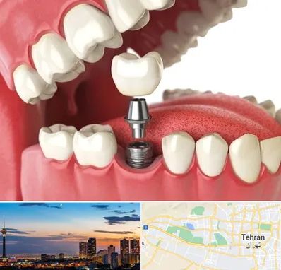 متخصص پروتز دندان در غرب تهران