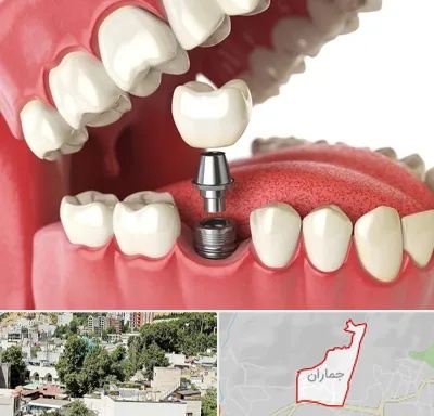 متخصص پروتز دندان در جماران