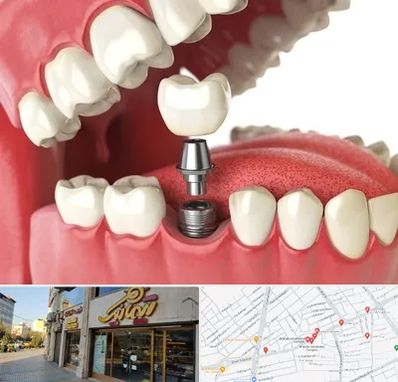 متخصص پروتز دندان در عطاران قم