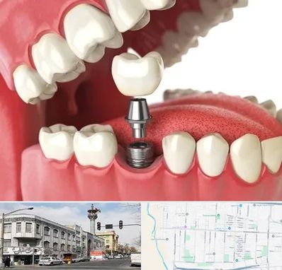 متخصص پروتز دندان در 17شهریور