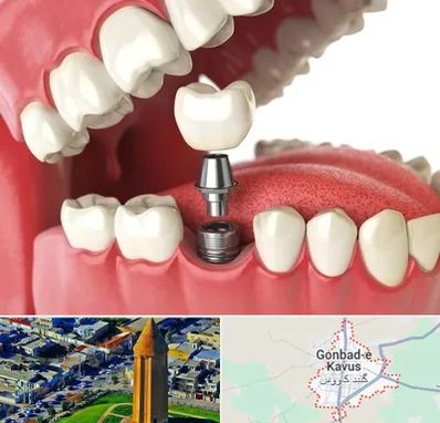 متخصص پروتز دندان در گنبد کاووس