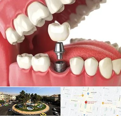 متخصص پروتز دندان در هفت حوض