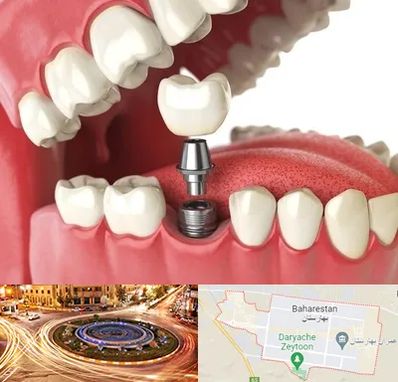 متخصص پروتز دندان در بهارستان