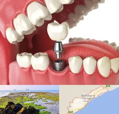 متخصص پروتز دندان در بندرلنگه