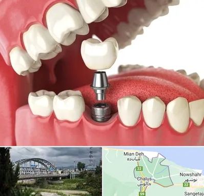 متخصص پروتز دندان در چالوس