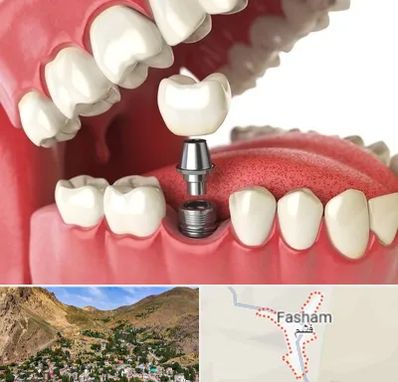 متخصص پروتز دندان در فشم