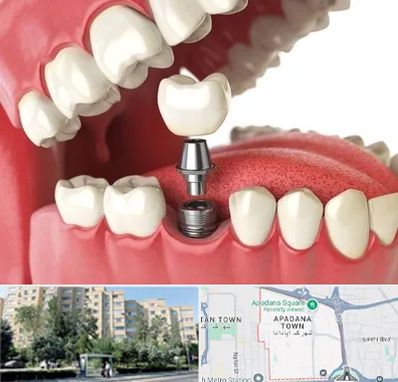 متخصص پروتز دندان در آپادانا
