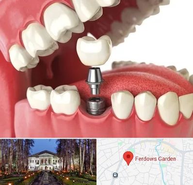 متخصص پروتز دندان در باغ فردوس