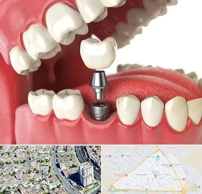 متخصص پروتز دندان در قاسم آباد مشهد