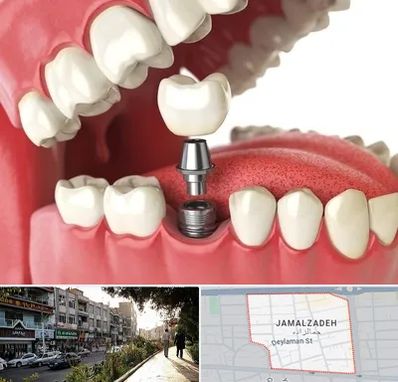 متخصص پروتز دندان در خیابان جمالزاده