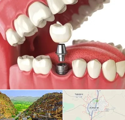 متخصص پروتز دندان در کامیاران