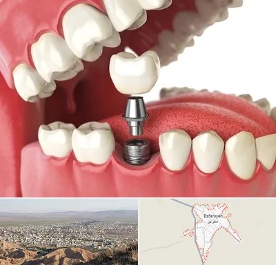 متخصص پروتز دندان در اسفراین