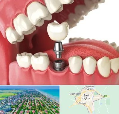 متخصص پروتز دندان در ساری