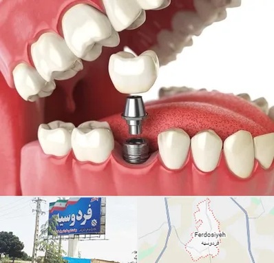 متخصص پروتز دندان در فردوسیه شهریار