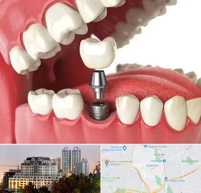 متخصص پروتز دندان در فرشته