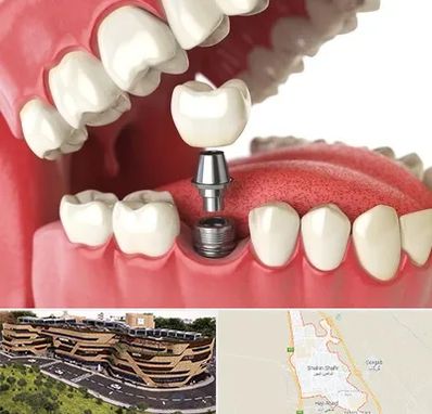 متخصص پروتز دندان در شاهین شهر