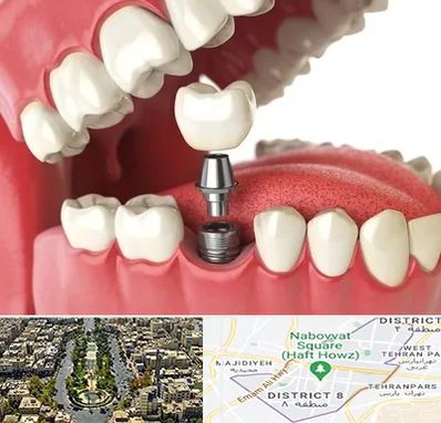 متخصص پروتز دندان در نارمک