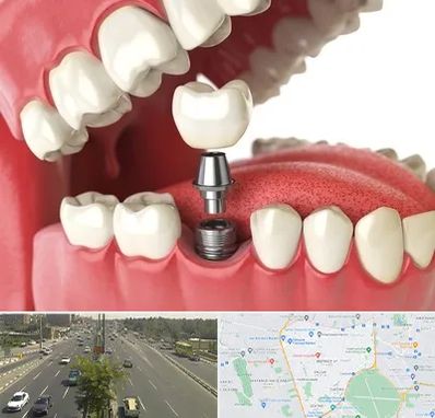 متخصص پروتز دندان در منطقه 17 تهران