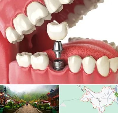 متخصص پروتز دندان در فومن