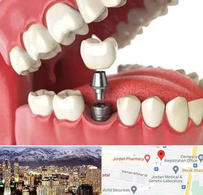متخصص پروتز دندان در جردن