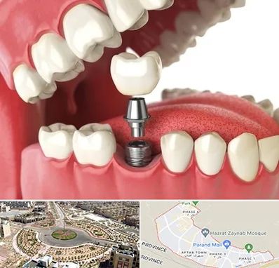 متخصص پروتز دندان در پرند