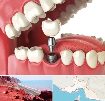 متخصص پروتز دندان در هرمزگان
