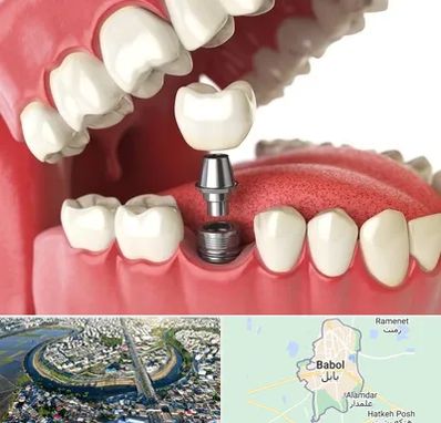 متخصص پروتز دندان در بابل
