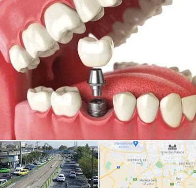 متخصص پروتز دندان در جنوب تهران