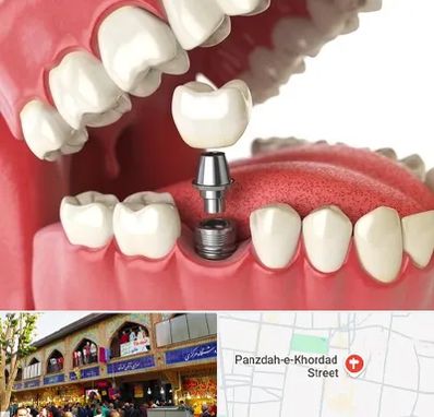 متخصص پروتز دندان در 15 خرداد