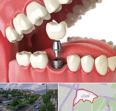 متخصص پروتز دندان در لویزان