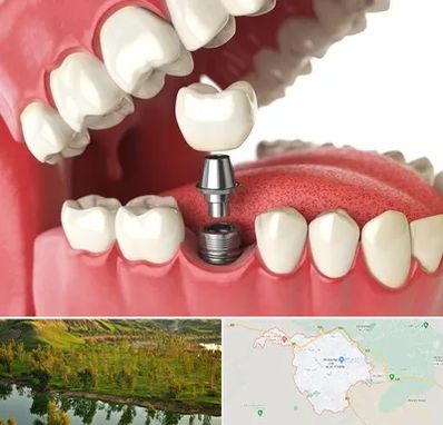 متخصص پروتز دندان در بهبهان