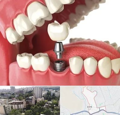 متخصص پروتز دندان در اوین