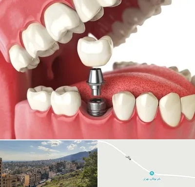 متخصص پروتز دندان در بوکان تهران