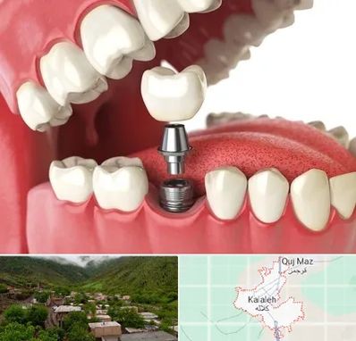 متخصص پروتز دندان در کلاله
