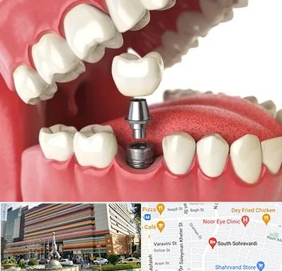 متخصص پروتز دندان در سهروردی