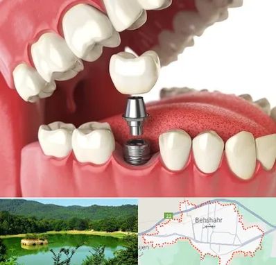 متخصص پروتز دندان در بهشهر